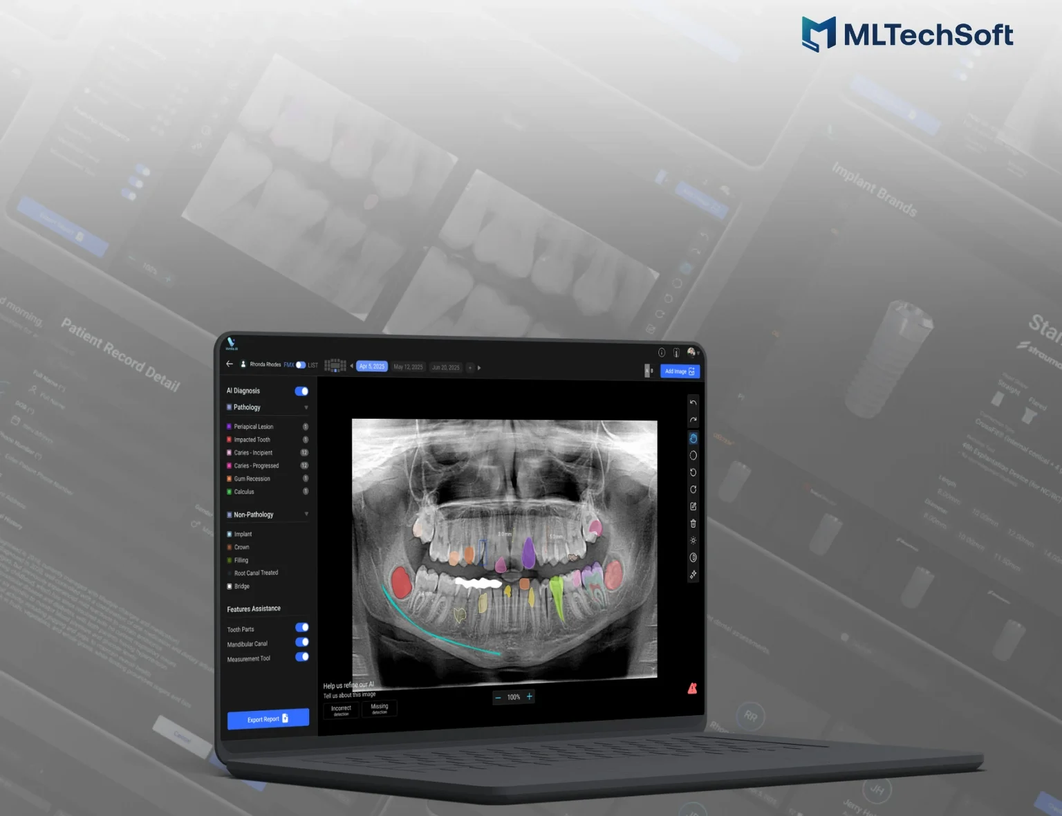 Screenshot of the AI system detecting dental conditions on an X-ray image with labeled annotations.